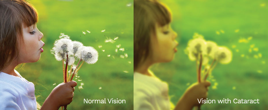 cataract vision comparison