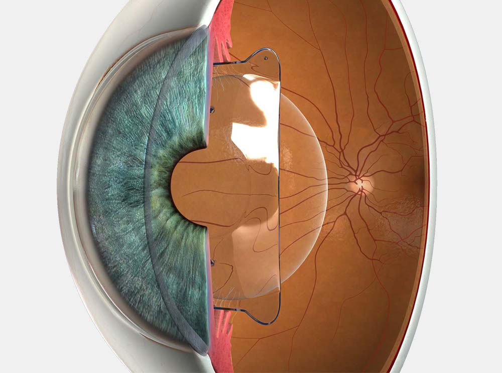 Implantable Contact Lens (ICL)