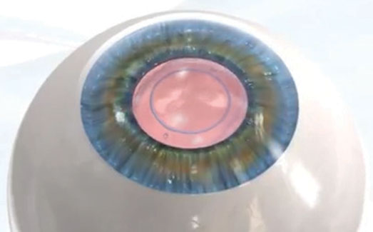 Implantable Contact Lens (ICL)