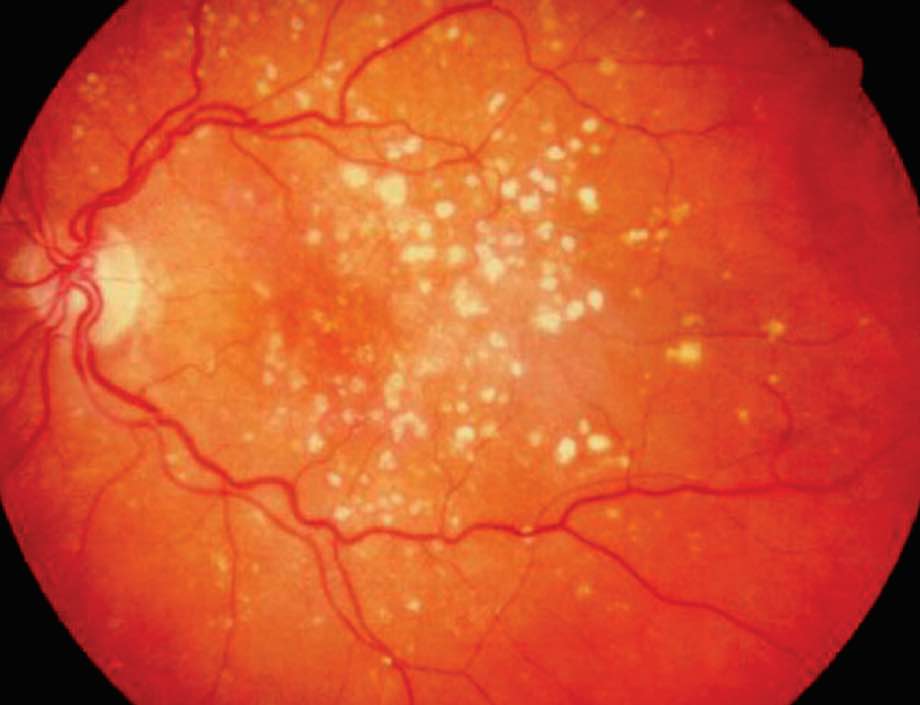 Age-Related Macular Degeneration