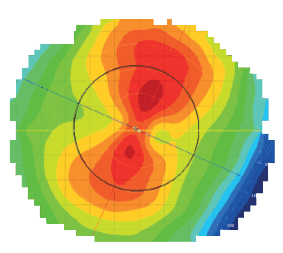 Cornea assessment