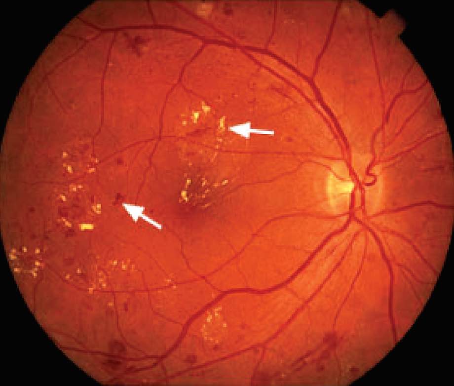 Glaucoma treatments