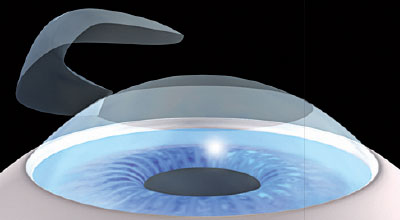 Femto-LASIK S