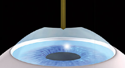 Femto-LASIK S