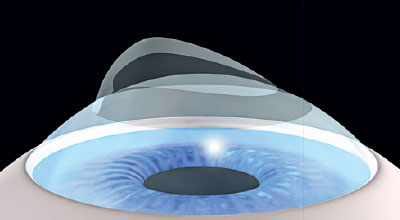 Femto-LASIK S