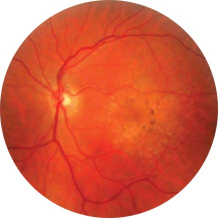 Cataract