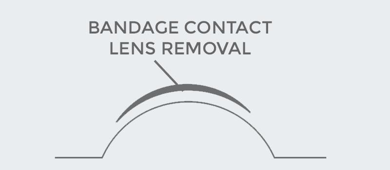 Advanced Surface Ablation (ASA)