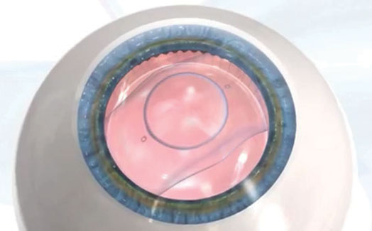 Implantable Contact Lens (ICL)