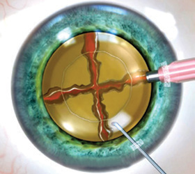 No-Blade Cataract Surgery