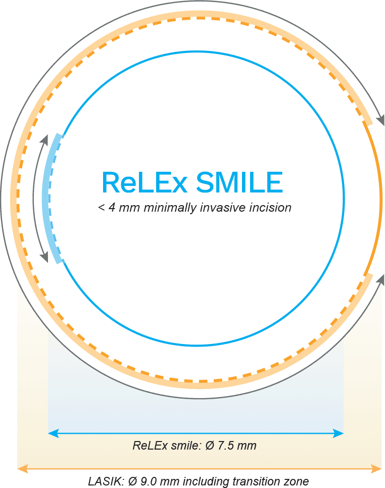 ReLEx SMILE