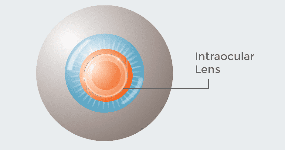 Refractive Lens Exchange RLE