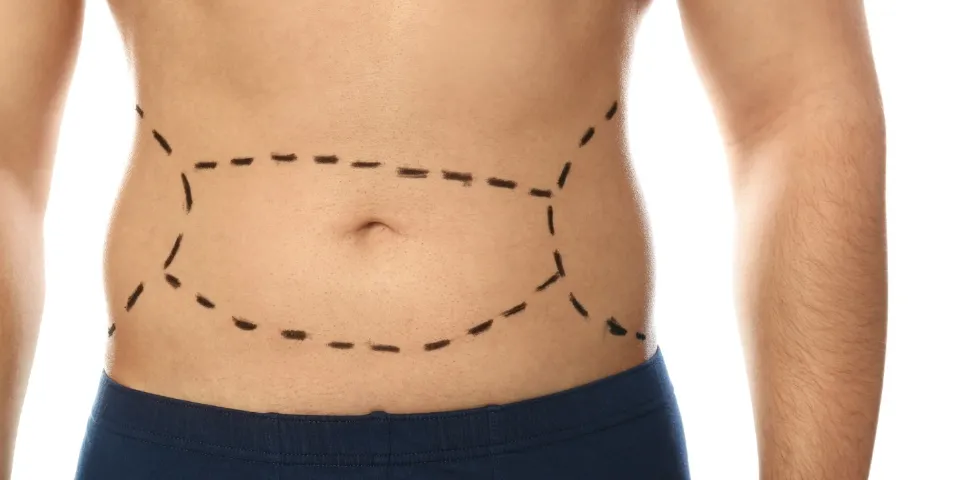 Liposuction