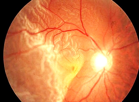 Retinal Detachment